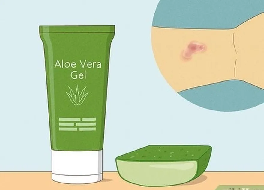 adım 7 kaşıntıya yardımcı olması için döküntünüze aloe vera uygulayın.