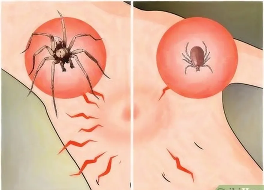 adım 3 don't confuse tick bites as spider bites.