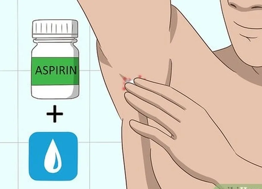 adım 8 diğer tedavilere alternatif olarak ısırığa karşı ıslak bir aspirin tutun.