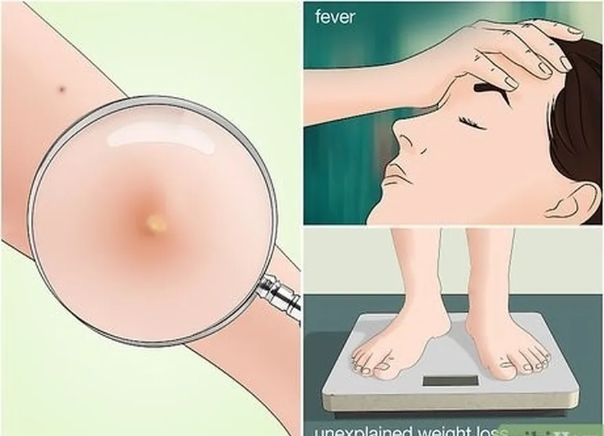 adım 2 kutanöz veya visseral leishmaniasis belirtilerini izleyin.